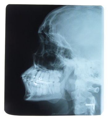 X-Ray of Head